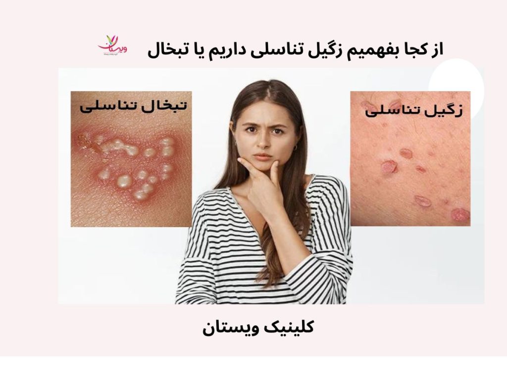 تبخال تناسلی از کجا بفهمیم زگیل تناسلی داریم یا تبخال