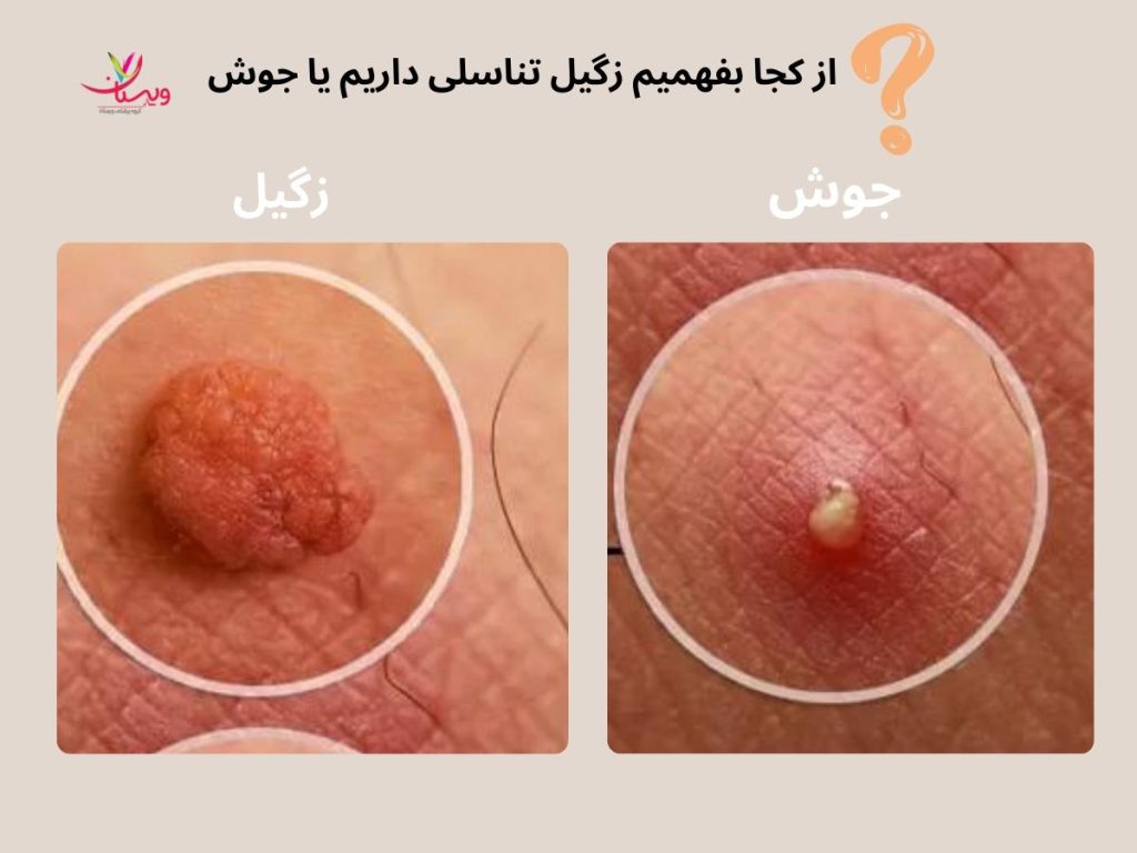 زگیل تناسلی از کجا بفهمیم زگیل تناسلی داریم یا جوش