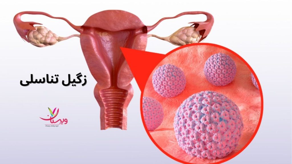 زگیلهای رشتهای انواع زگیل تناسلی