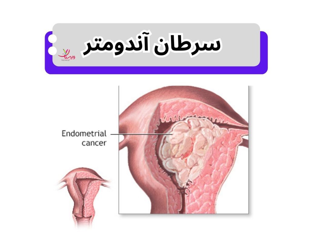هیپرپلازی آندومتر سرطان رحم