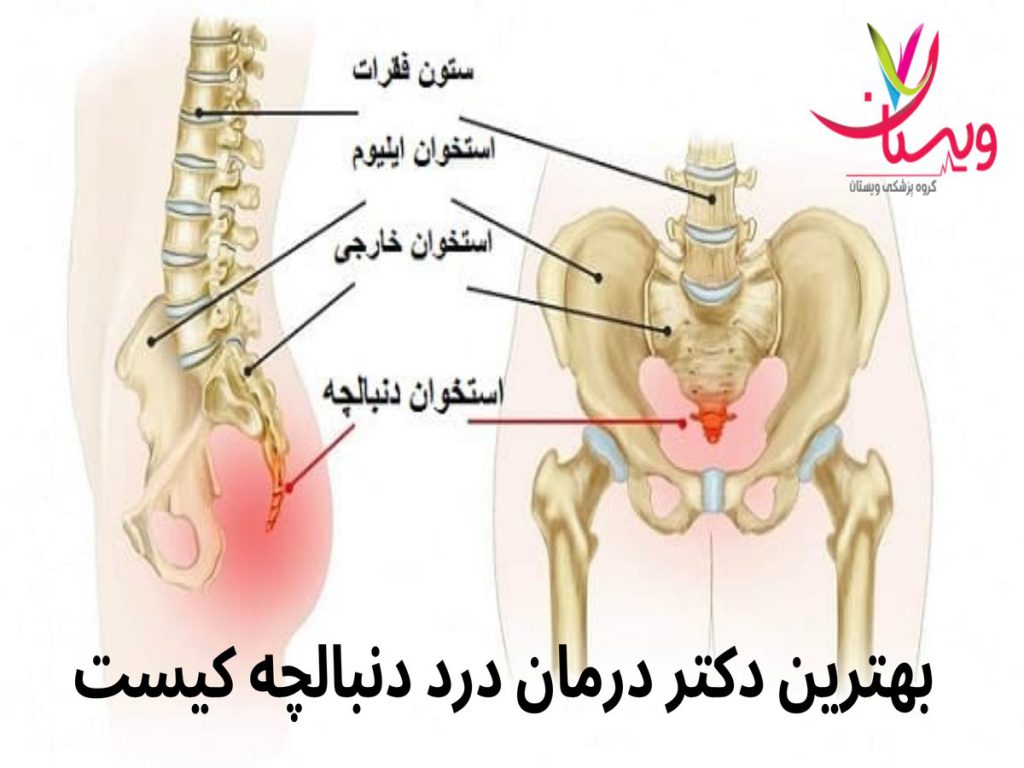 بهترین دکتر درمان درد دنبالچه کیست