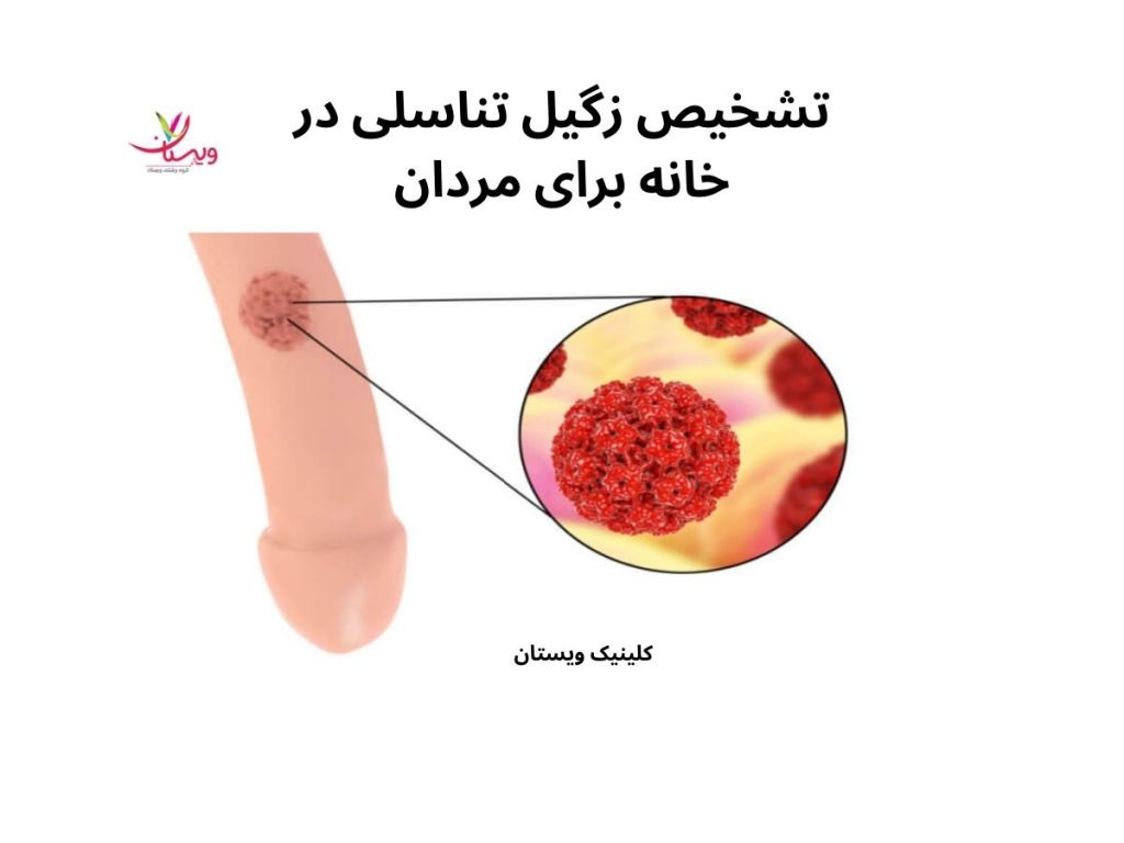 تشخیص زگیل تناسلی تشخیص زگیل تناسلی در خانه برای مردان