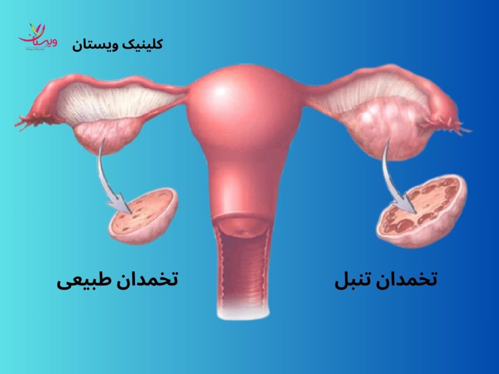 سلامت تخمدانها تصاویر تنبلی تخمدان