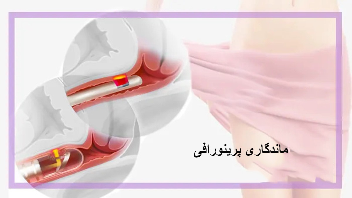 ماندگاری پرینورافی ماندگاری عمل تنگ کردن واژن