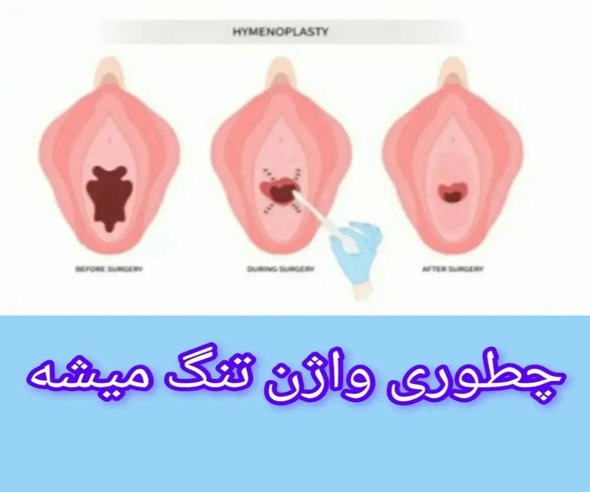 روش جراحی پرینورافی چطوری واژن تنگ میشه