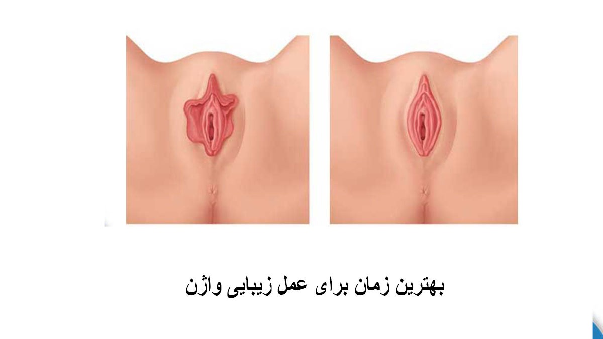 بهترین زمان برای عمل زیبایی واژن