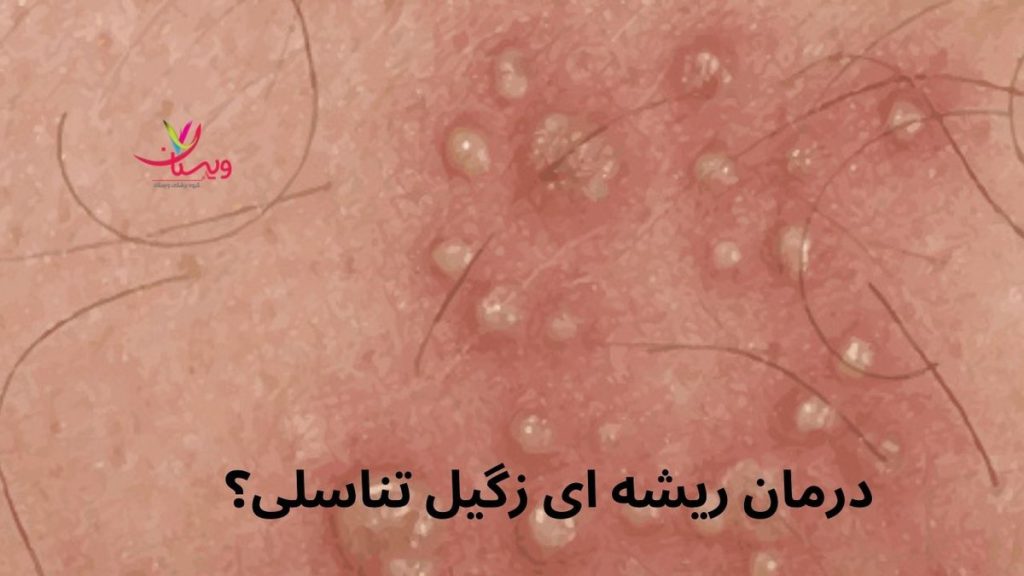 ویروس HPV درمان ریشه ای زگیل تناسلی