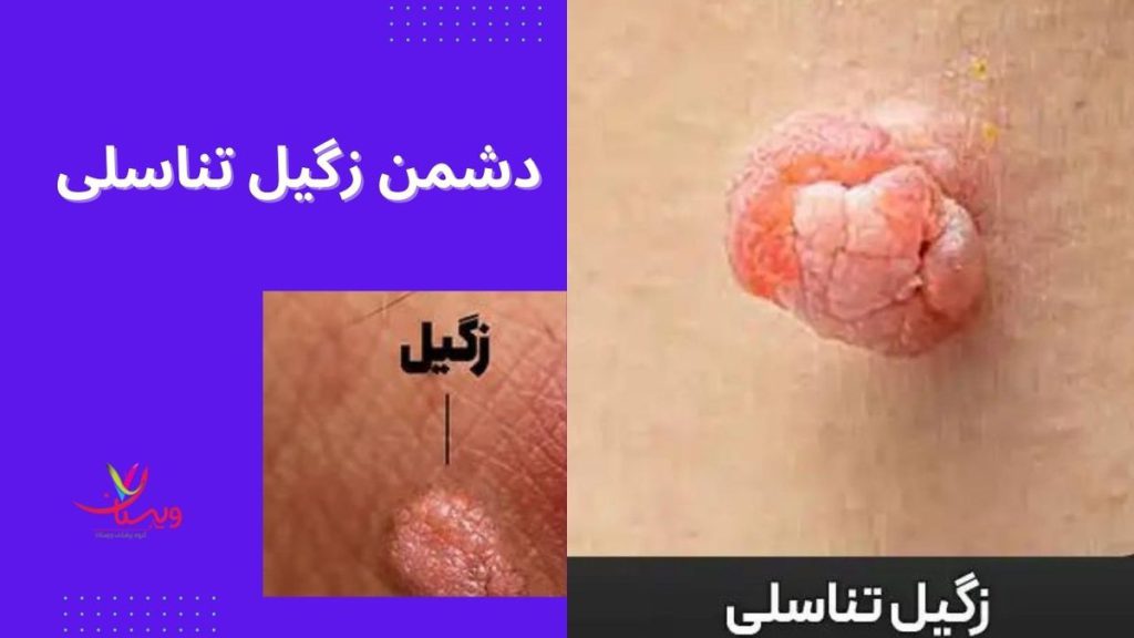 دشمن زگیل تناسلی
