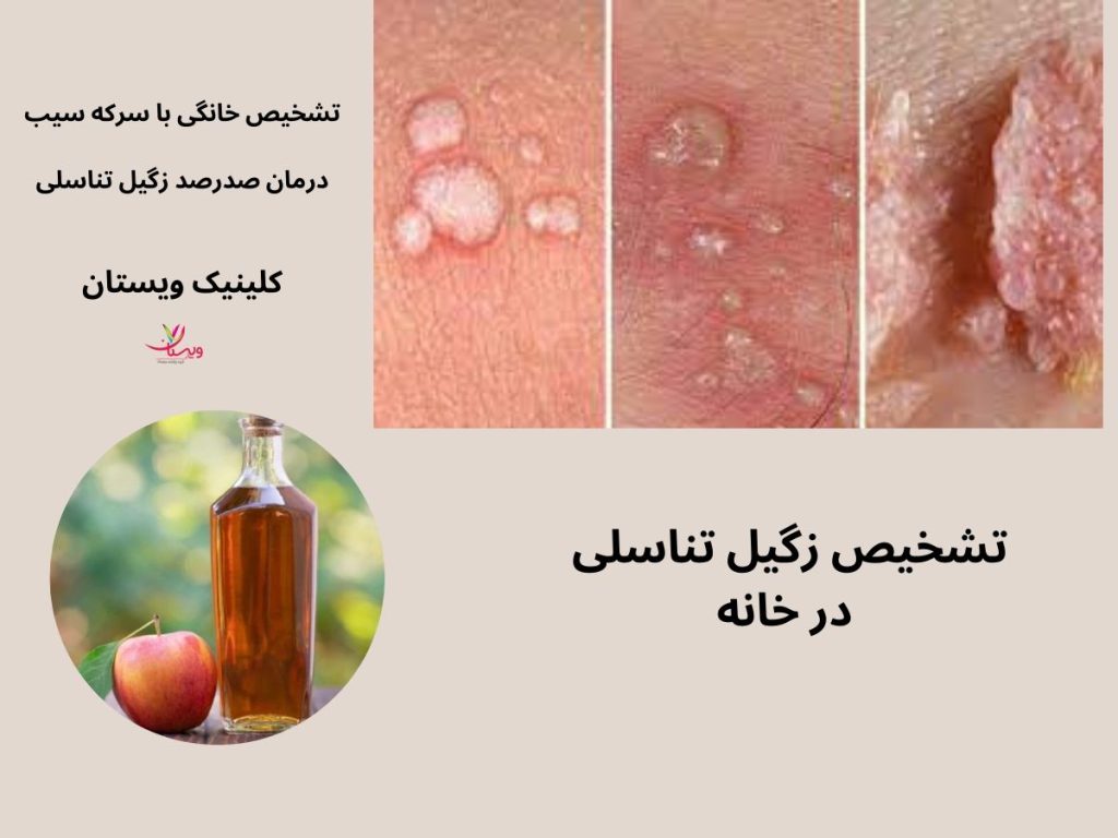 تشخیص زگیل تناسلی در خانه