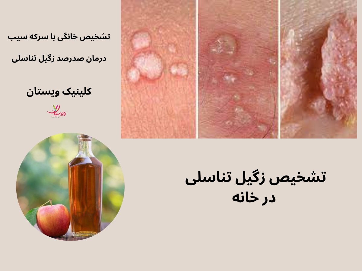 تشخیص زگیل تناسلی در خانه
