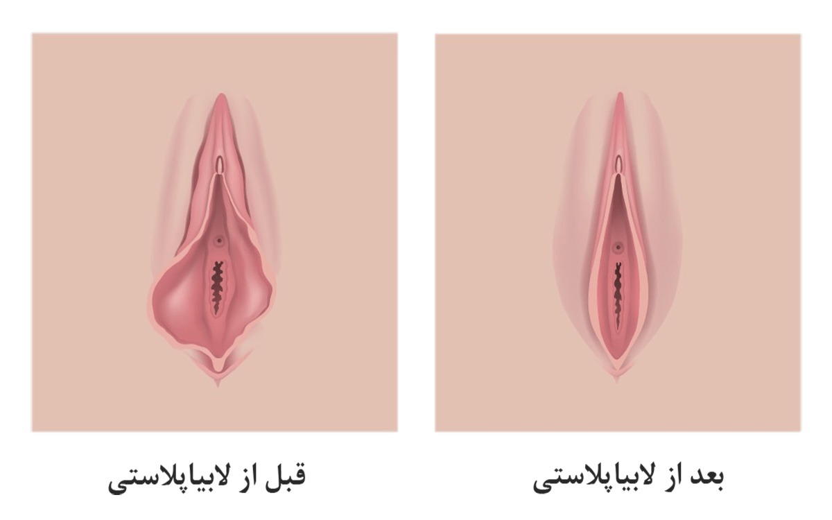 تصویری از نتیجه لابیاپلاستی قبل و بعد عمل لابیاپلاستی