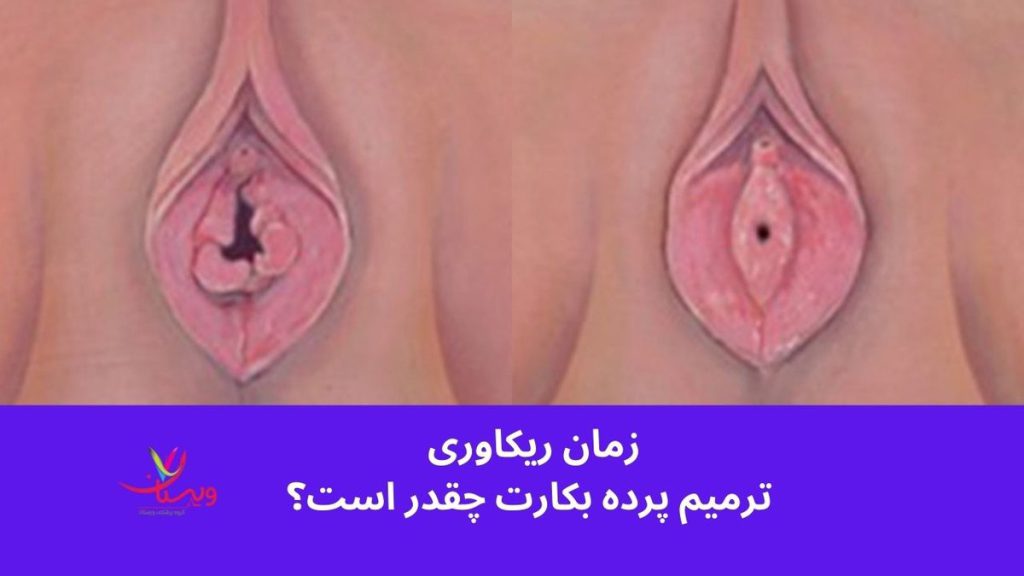 زمان ریکاوری ترمیم پرده بکارت چقدر است
