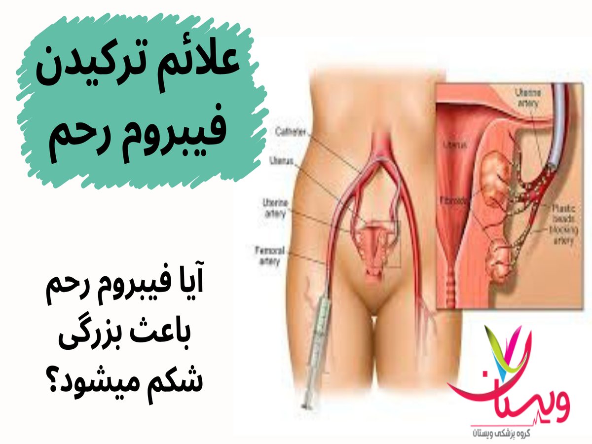 علائم ترکیدن فیبروم رحم