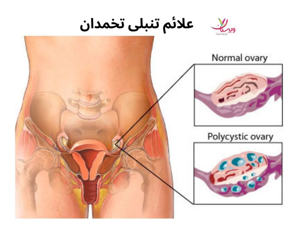 سندرم تخمدان پلیکیستیک علائم تنبلی تخمدان