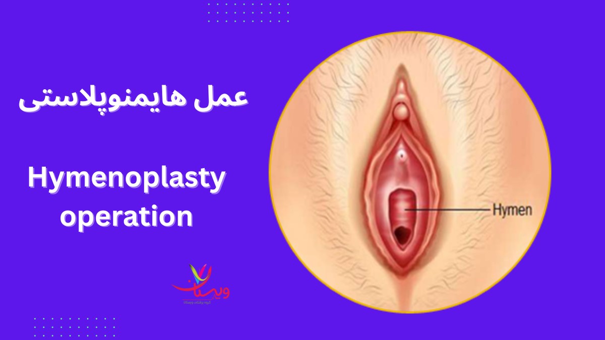 عمل هایمنوپلاستی