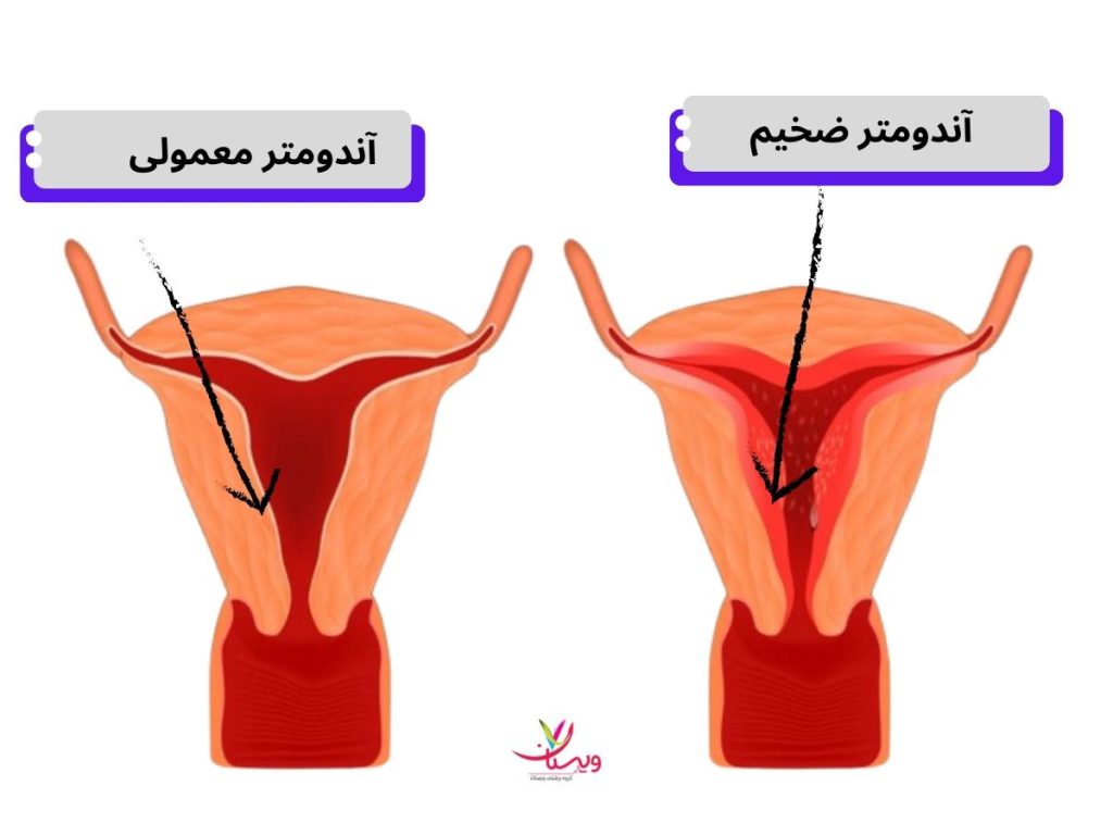 پولیپ رحم عکس ضخیم شدن دیواره رحم