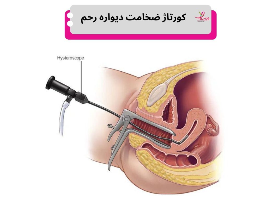 کورتاژ ضخامت دیواره رحم