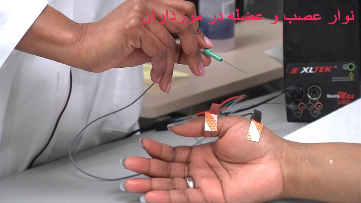 نوار عصب و عضله در مرزداران
