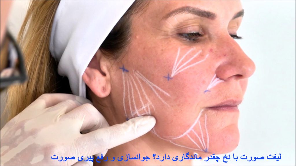 لیفت صورت با نخ چقدر ماندگاری دارد؟ جوانسازی و رفع پیری صورت