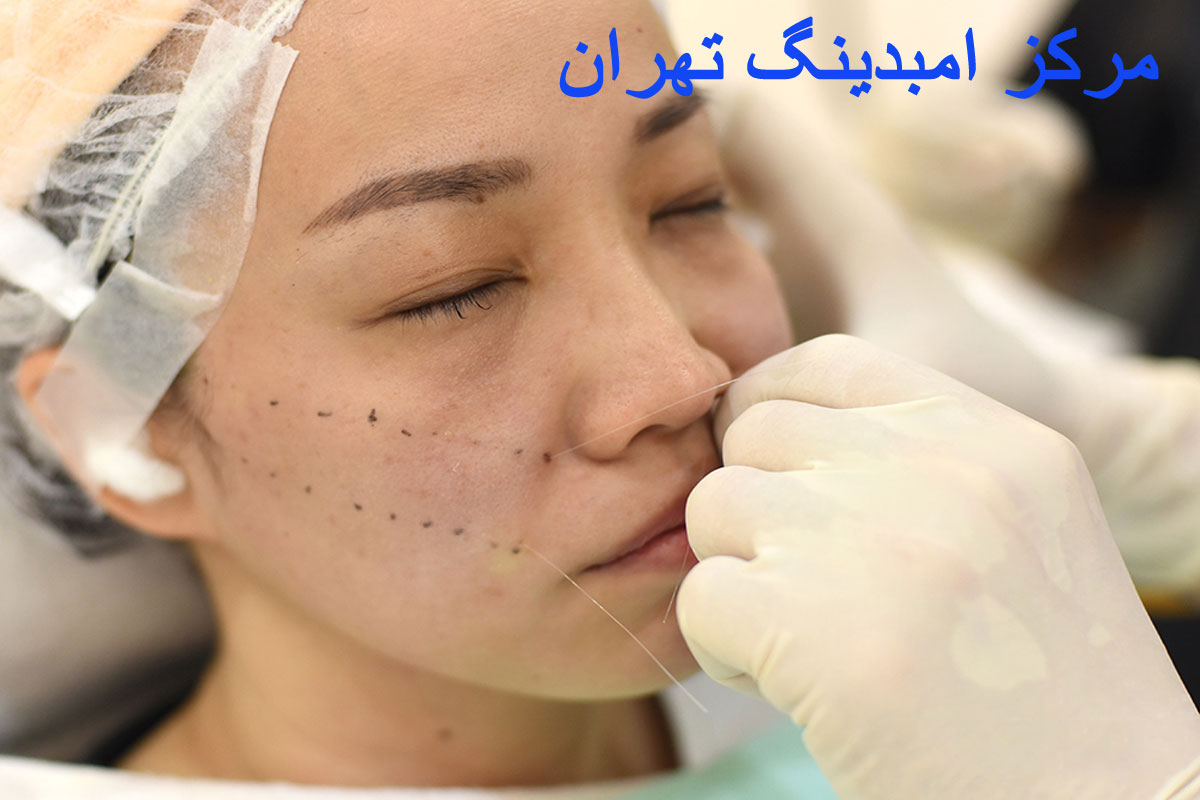 امبدینگ صورت بهترین مرکز امبدینگ صورت تهران