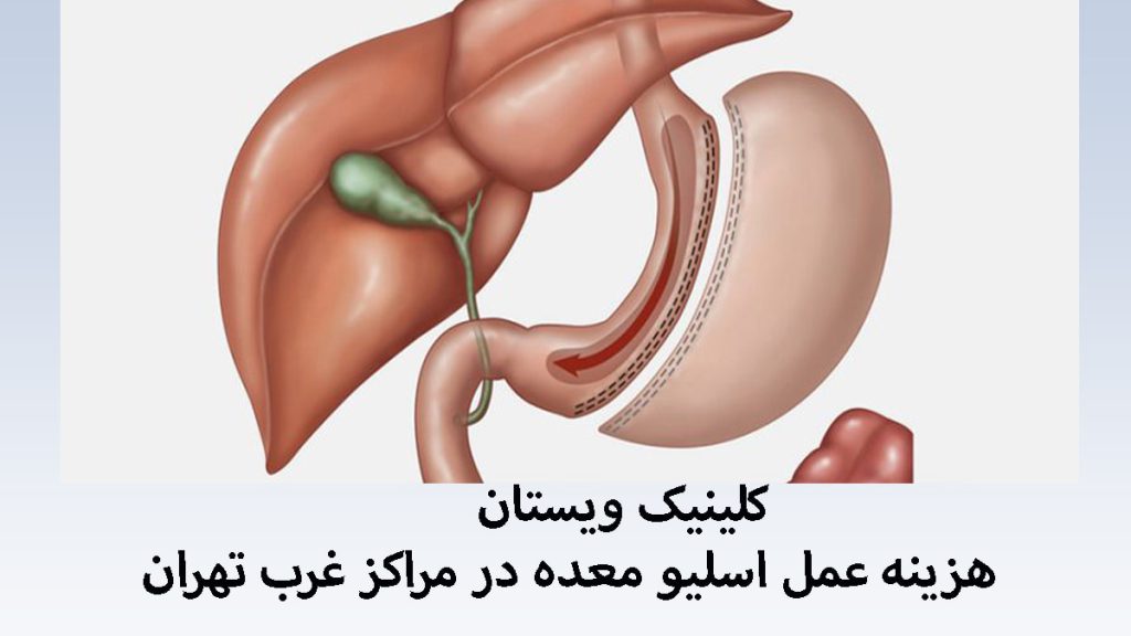 یک معده انسان که عمل اسلیو بر روی آن نمایش داده شده است