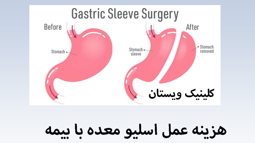 معده انسان قبل و بعد از عمل اسلیو معده-تصویر انیمیشنی است