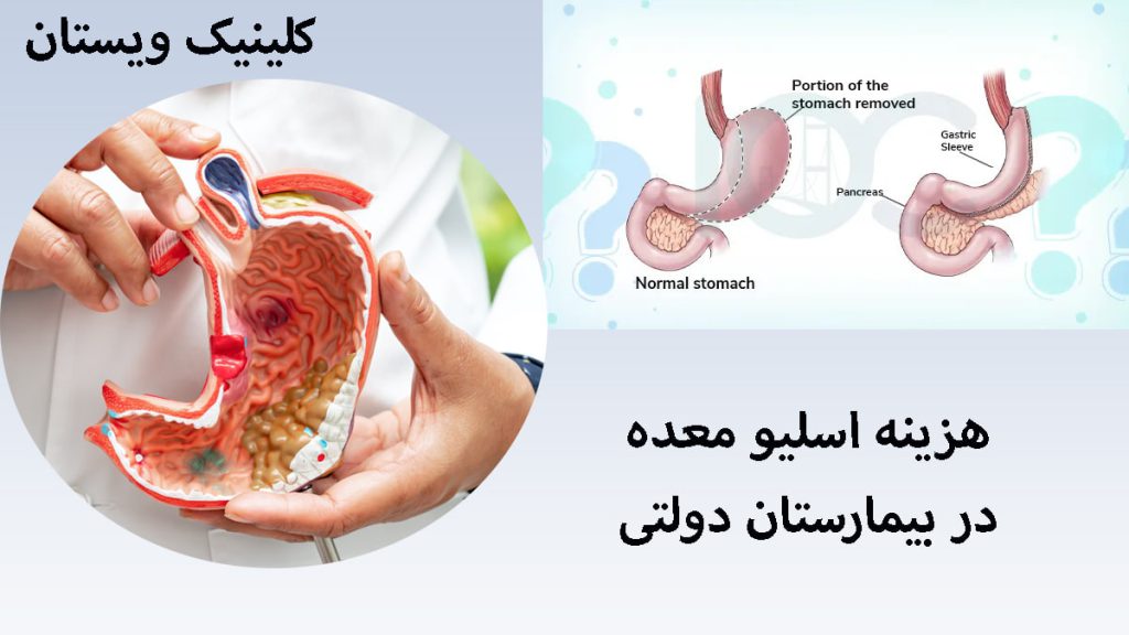 دو تصویر از عمل اسلیو معده