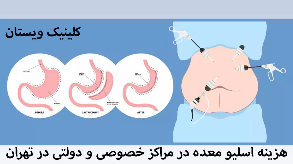 مراحل مختلف عمل اسلیو معده