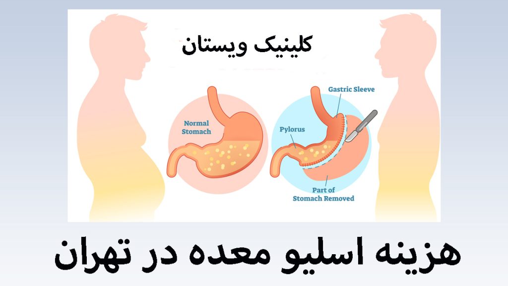 تصویر انیمیشنی از یک شخص قبل و بعد از عمل اسلیو معده-نوشته با عنوان هزینه اسلیو معده