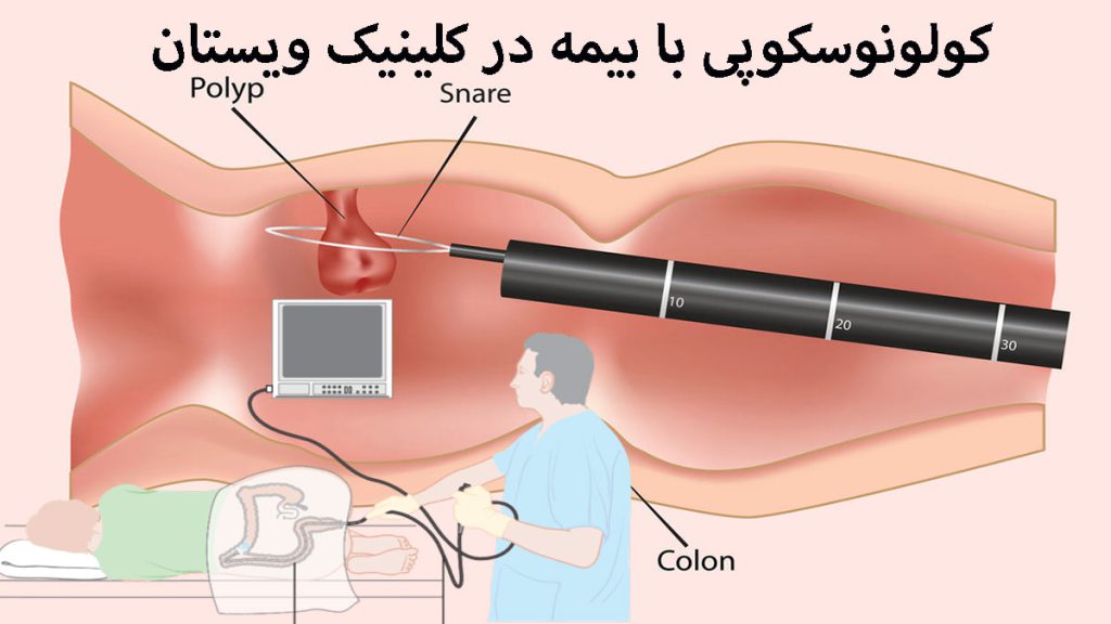 دو تصویر انیمیشنی از انجام کولونوسکوپی توسط پزشک