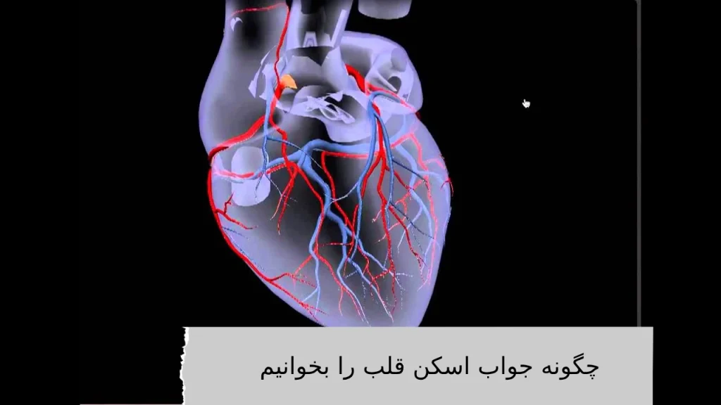 چگونه جواب اسکن قلب را بخوانیم اسکن هستهای قلب