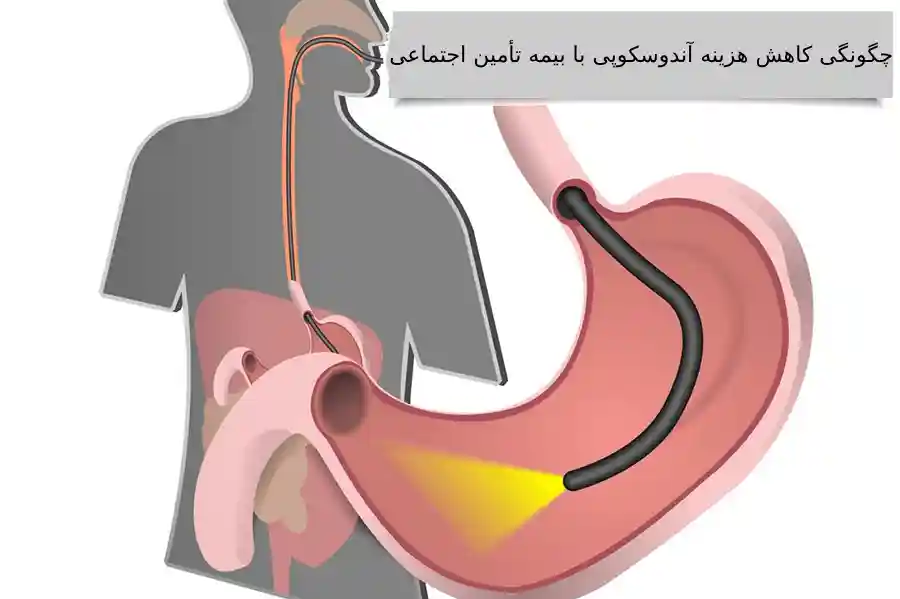 هزینه آندوسکوپی با بیمه تأمین اجتماعی چقدر است؟