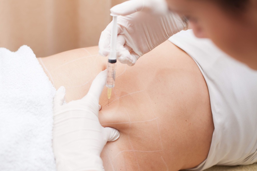 عوارض مزوتراپی عوارض مزوتراپی لاغری شکم