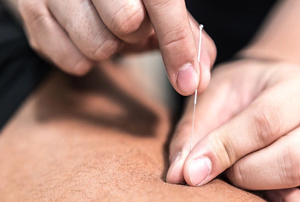 جلسات طب سوزنی تعداد جلسات طب سوزنی برای لاغری