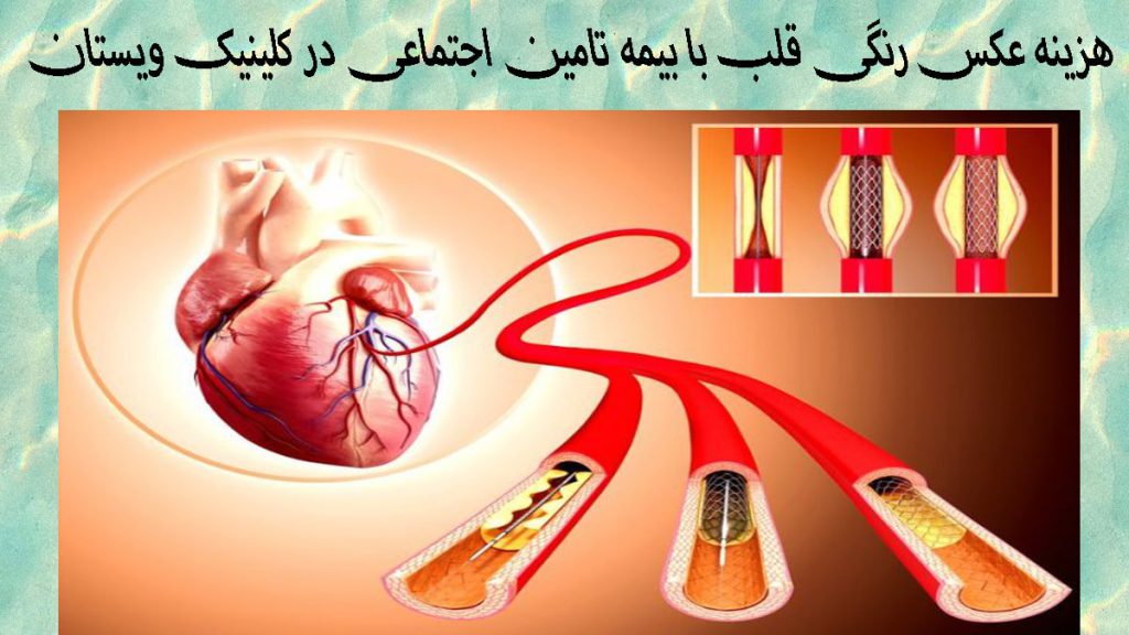 هزینه عکس رنگی قلب یک تصویر انیمیشنی از آنژیوگرافی قلب-نوشته با عنوان هزینه عکس رنگی قلب با بیمه تامین اجتماعی