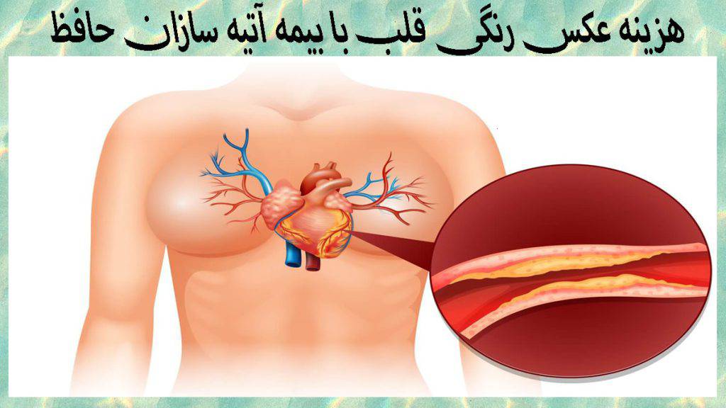 تصویری بزرگ نمایی شده از رگ قلب یک شخص که دچار گرفتگی شده