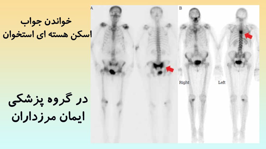 تصویر رادیولوژی از اسکن استخوان