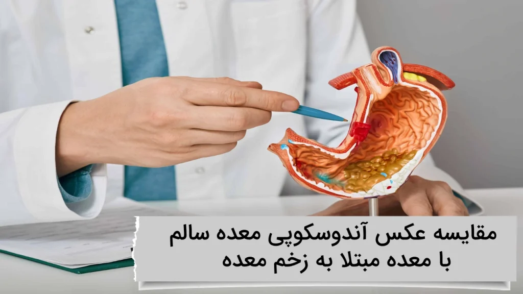 مقایسه عکس آندوسکوپی معده سالم با معده مبتلا به زخم معده