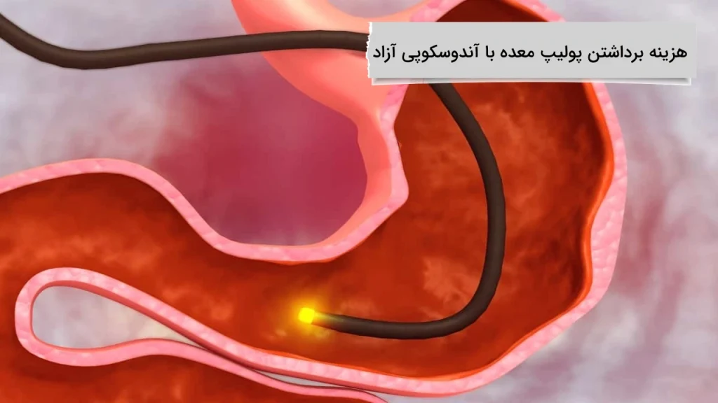 نکات کامل هزینه برداشتن پولیپ معده با آندوسکوپی آزاد
