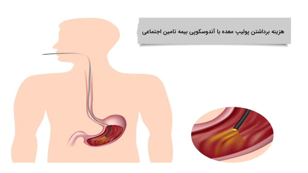 نکات کامل هزینه برداشتن پولیپ معده با آندوسکوپی بیمه تامین اجتماعی