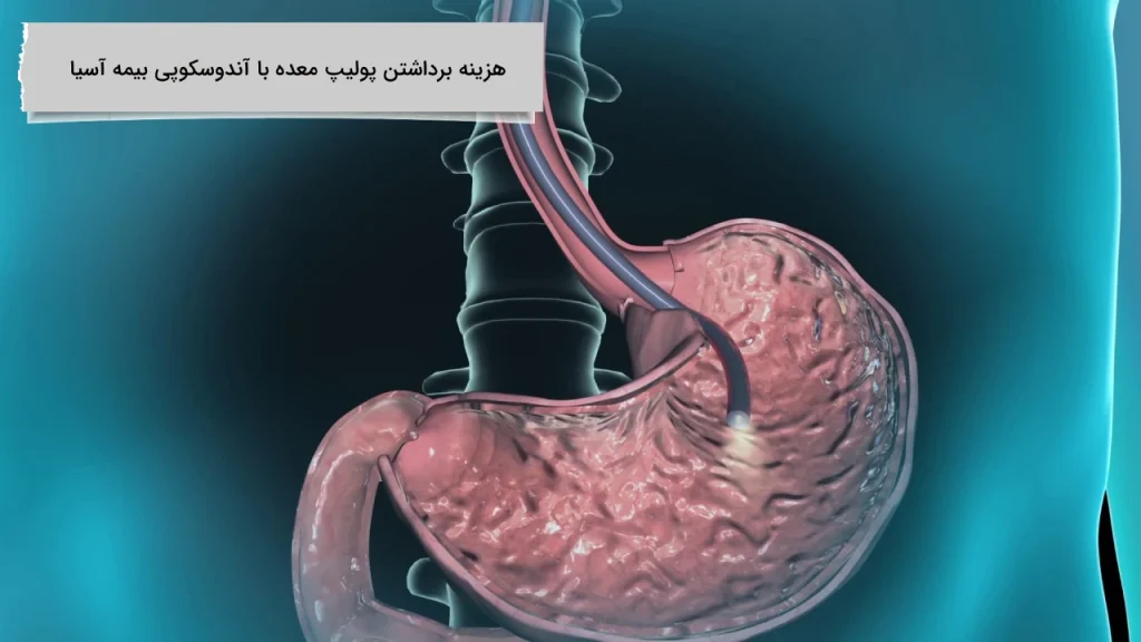 تمامی نکات هزینه برداشتن پولیپ معده با آندوسکوپی بیمه آسیا