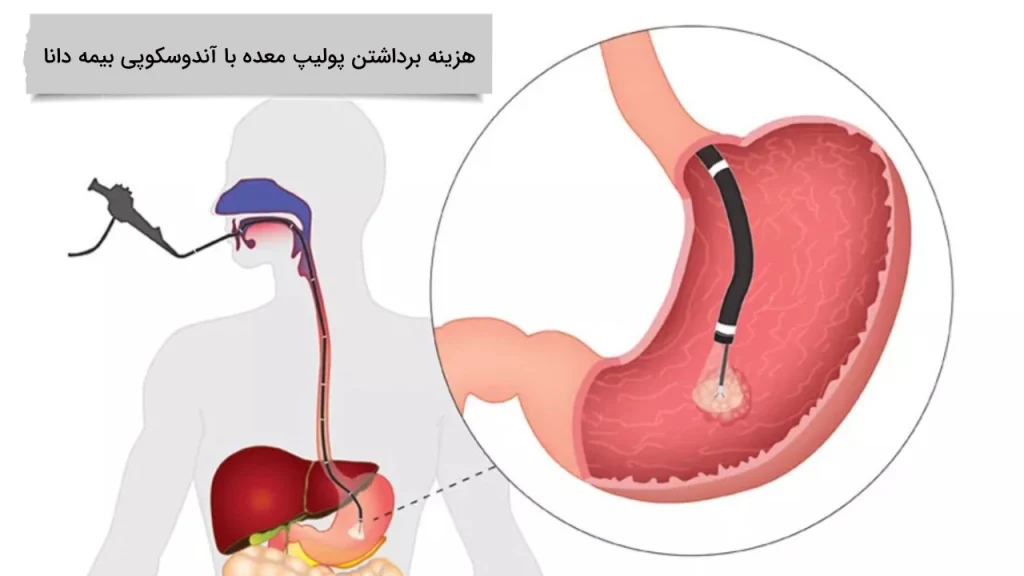 تمامی نکات هزینه برداشتن پولیپ معده با آندوسکوپی بیمه دانا