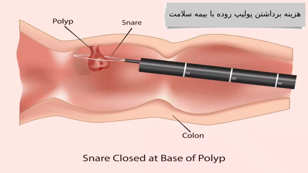 هزینه برداشتن پولیپ روده با بیمه سلامت جزئیات کامل هزینه برداشتن پولیپ روده با انواع بیمه ها