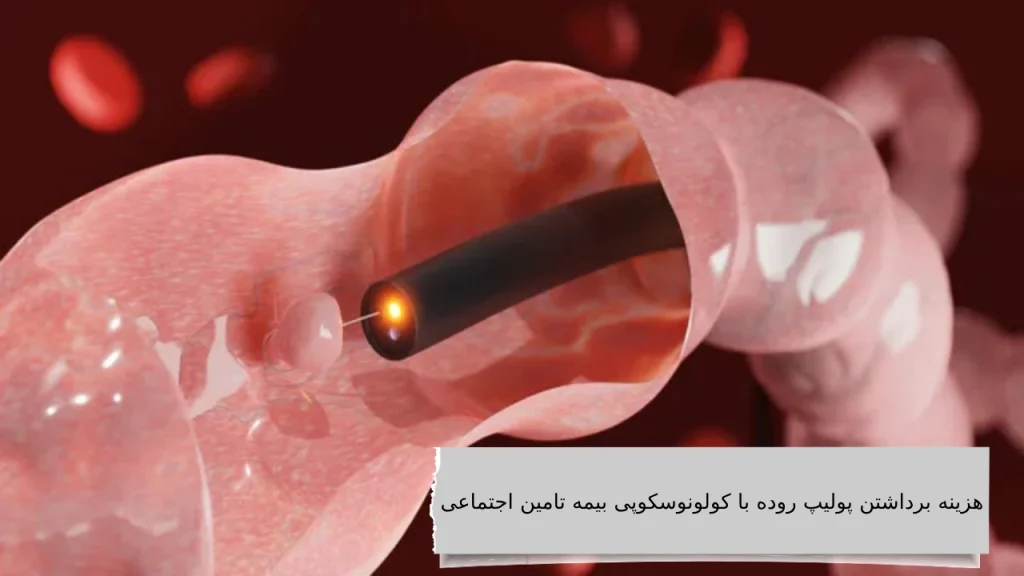 همراه ما دانستن بهترین هزینه برداشتن پولیپ روده با کولونوسکوپی کاری نداره!