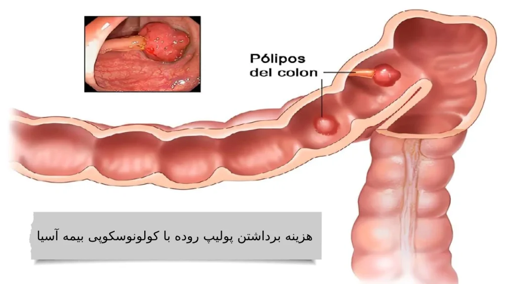 همراه ما دانستن بهترین هزینه برداشتن پولیپ روده با کولونوسکوپی کاری نداره!