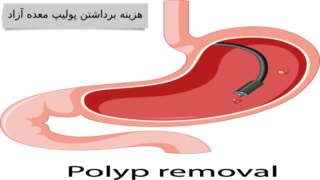 مقایسه هزینه برداشتن پولیپ معده با انواع بیمه ها