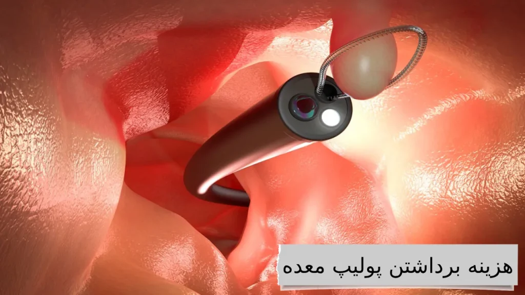 مقایسه هزینه برداشتن پولیپ معده با انواع بیمه ها