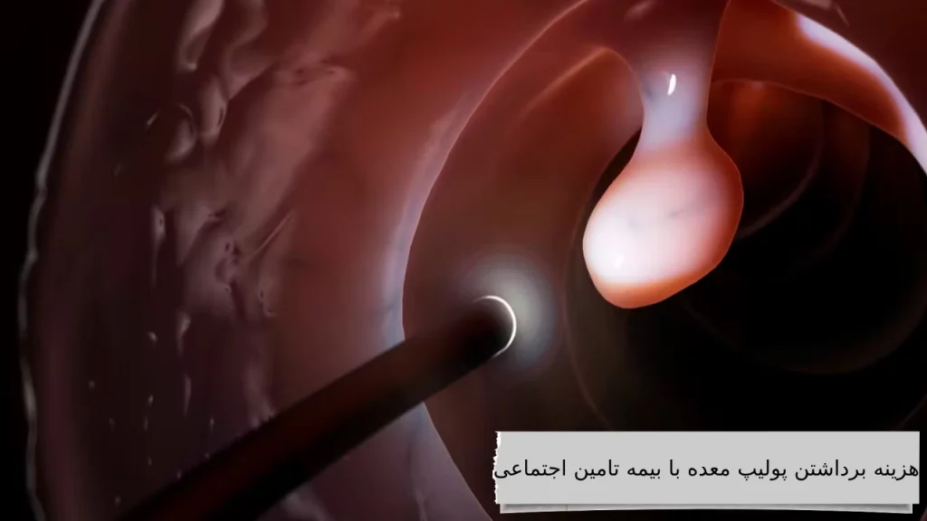 مقایسه هزینه برداشتن پولیپ معده با انواع بیمه ها