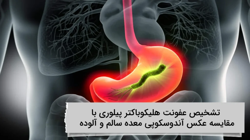 تشخیص عفونت هلیکوباکتر پیلوری با مقایسه عکس آندوسکوپی معده سالم و آلوده