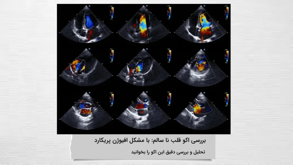 اکو قلب ناسالم با مشکل افیوژن پریکارد اکو قلب ناسالم با مشکل افیوژن پریکارد